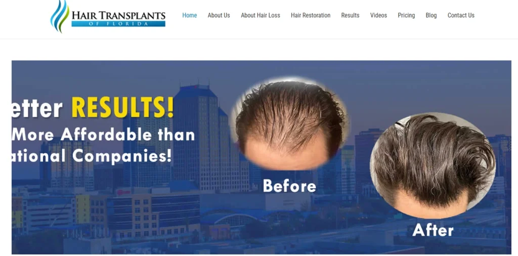 Hair Transplant Orlando