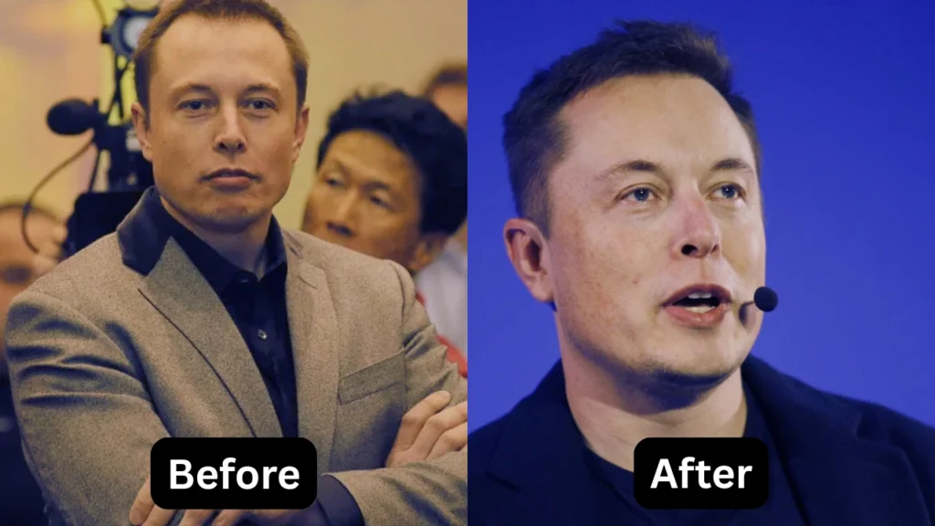Elon Musk Before After Hair Transplant