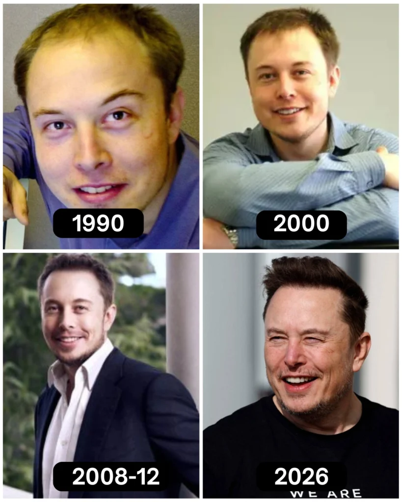 Elon Musk Hair Transplant