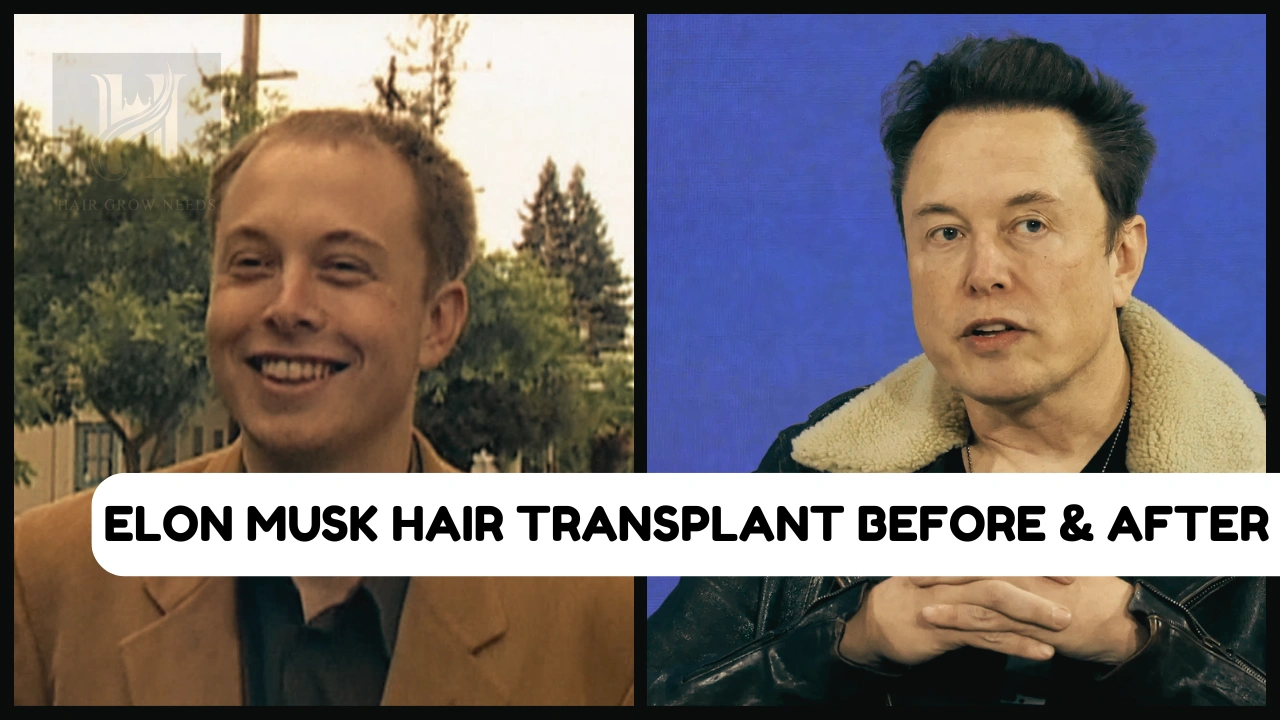 Elon Musk Hair Transplant