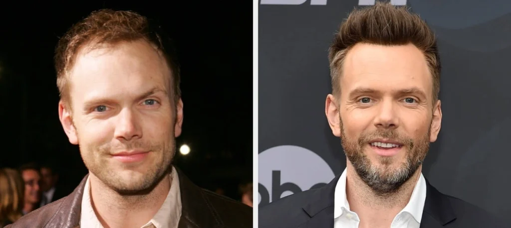 Joel McHale hair transplant