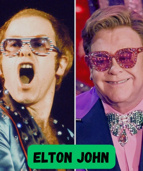 Elton John Hair Transplant