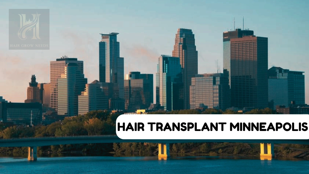 Hair Transplant Minneapolis