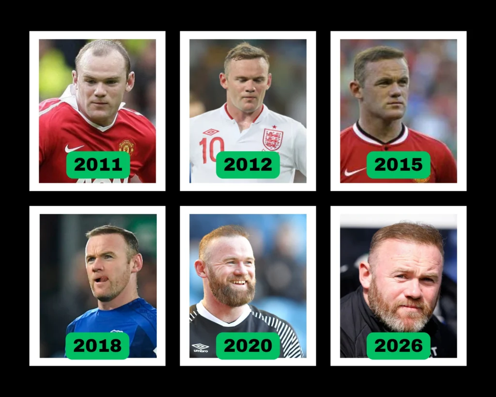 Wayne Rooney Hair Transplant