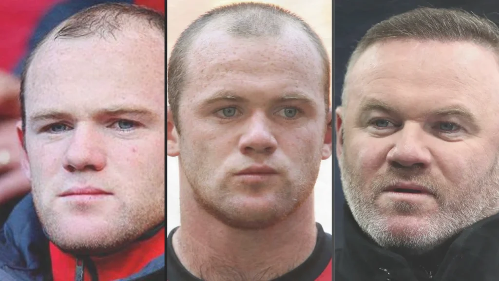 Wayne Rooney Hair Transplant Cost in 2026