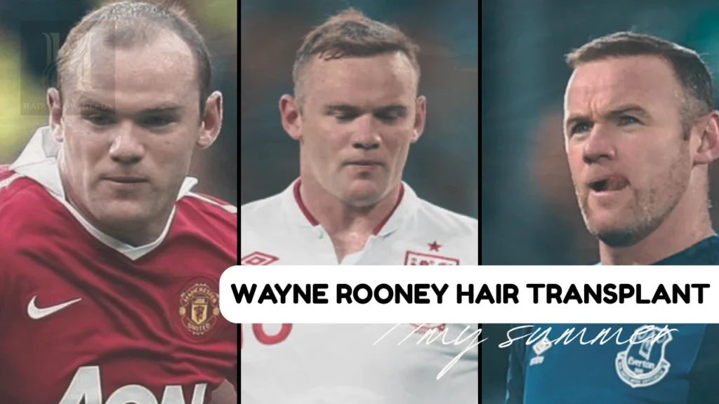 Wayne Rooney Hair Transplant