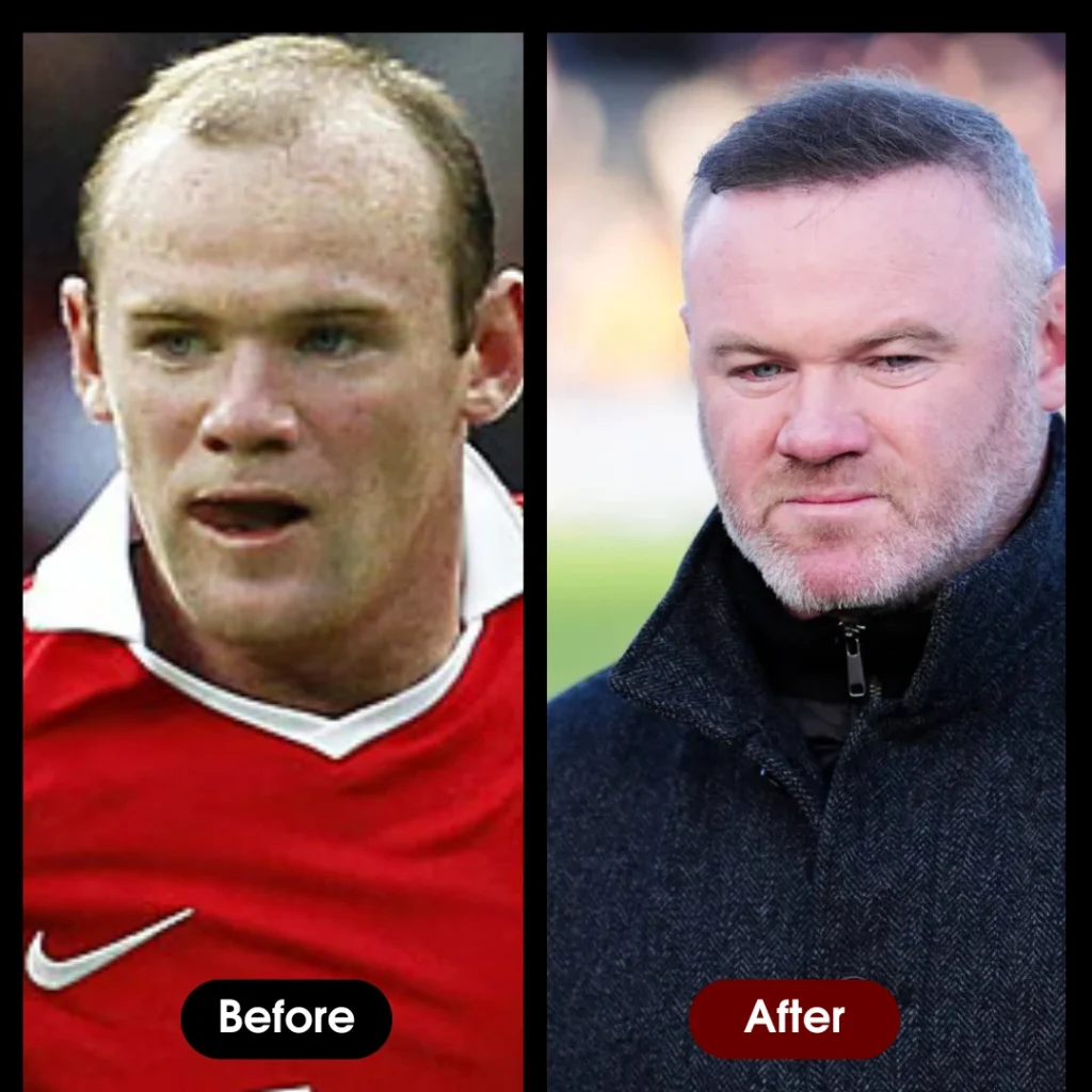Wayne Rooney Hair Transplant before & after