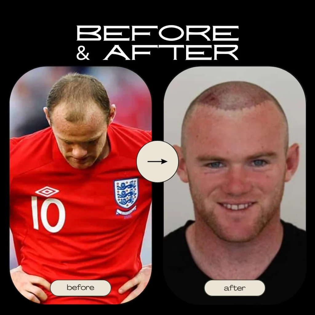 Why the Wayne Rooney Hair Transplant Became a Global Story