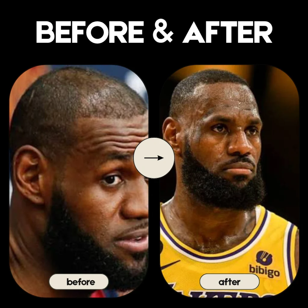 LeBron James hair transplant before and after hairline comparison
