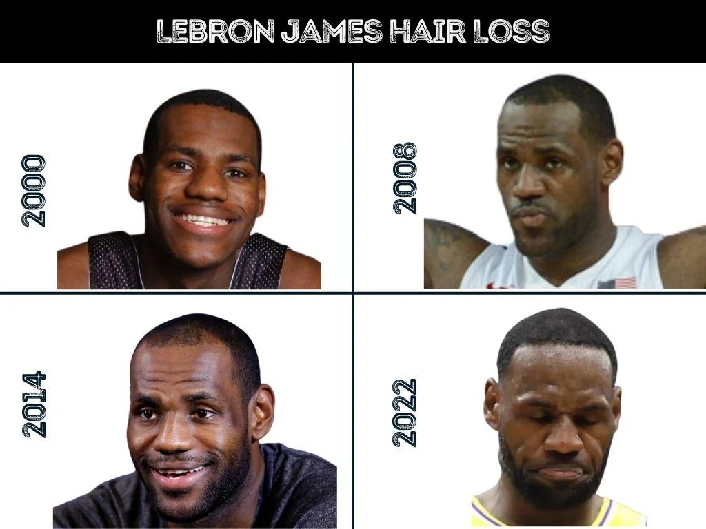 LeBron James hairline changes across his hair restoration timeline