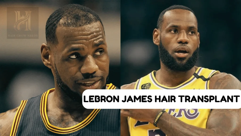 Lebron james Hair Transplant