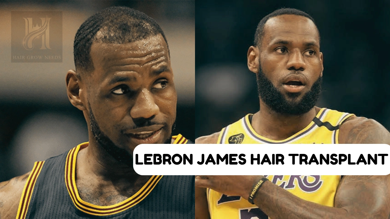 Lebron james Hair Transplant